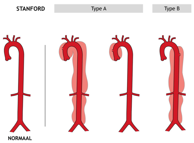 Stanford type A en B