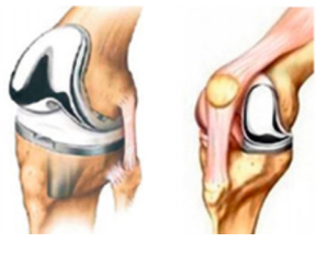 orthopedie-uw-knieoperatie-stap-voor-stap-1