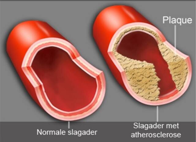 Afbeelding 1: Atherosclerose in de coronairen