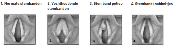 Stembanden